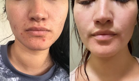 Before and after hormonal acne